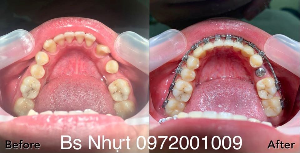 8 Tháng niềng răng Kết hợp cắm 1 implant Kontack