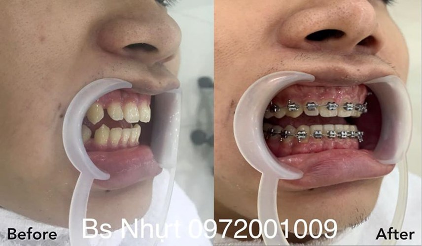 8 Tháng niềng răng Kết hợp cắm 1 implant Kontack