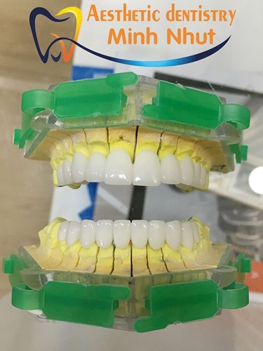 Làm răng sứ tại Nha khoa Minh Nhựt